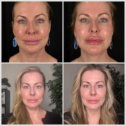 No makeup Holiday Glow Up progress: Top Left: Before; Top Right: Immediately following filler and red light therapy; Bottom Left: 24 hours after filler and red light therapy; Bottom Right: Final Glow-Up After filler and salmon DNA facial